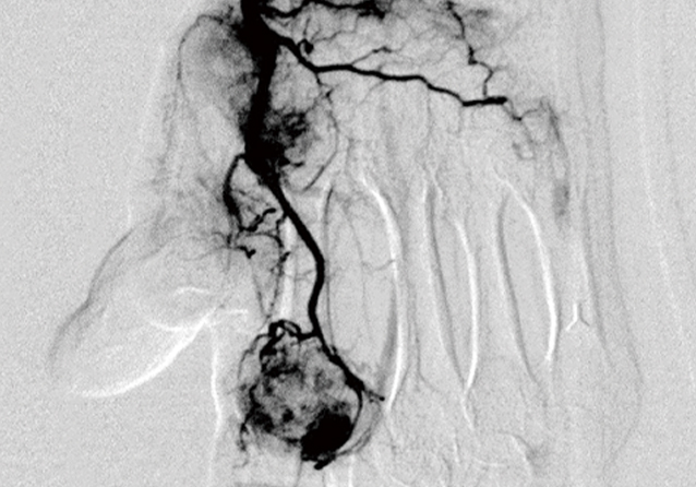 モヤモヤ血管とは?