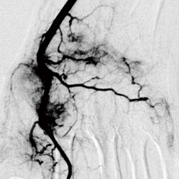 モヤモヤ血管の発生