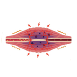 痛みが長引く慢性化状態へ