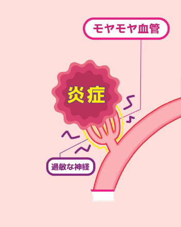 モヤモヤ血管を正確に見つけ、ピンポイントで薬剤を届ける