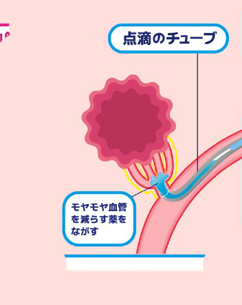 異常な血管だけを塞ぐしくみ