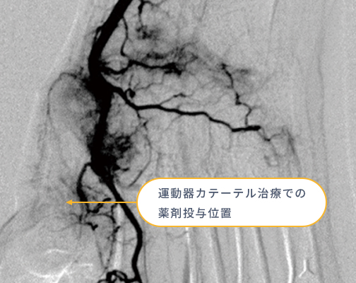 運動器カテーテル